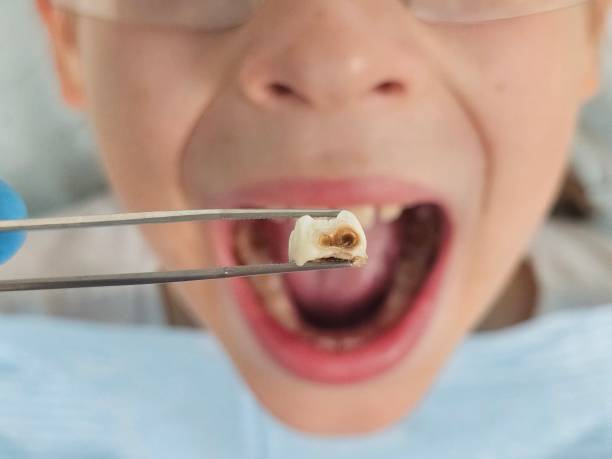 Best Emergency Treatment for Dental Infections or Abscesses in Finderne, NJ